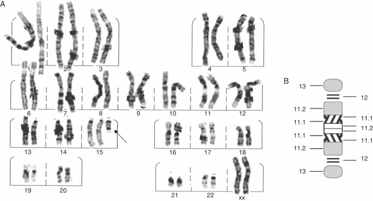 Хромосомы краба. Синдром Ангельмана кариотип. Синдром Микроделеции 15 хромосомы.