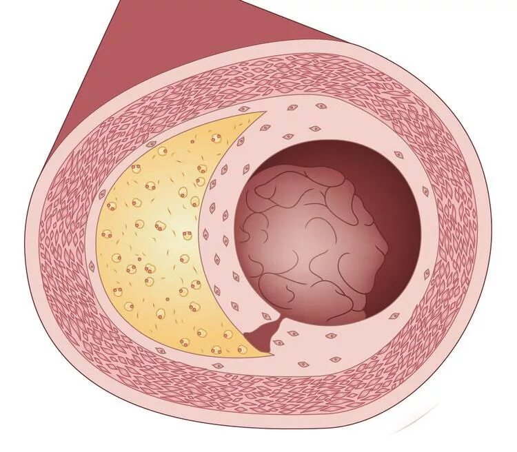 Отложение холестерина. Атеросклеротическая бляшка. Атеросклероз фиброзные бляшки. Атеросклероз холестериновая бляшка. Фиброзная и атероматозная бляшка.