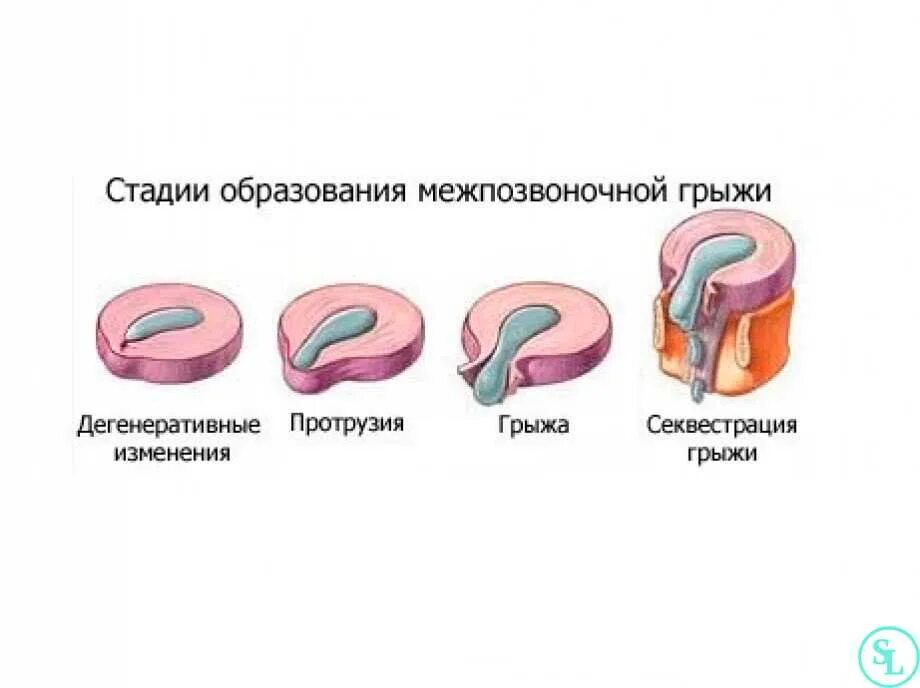 Протрузия это
