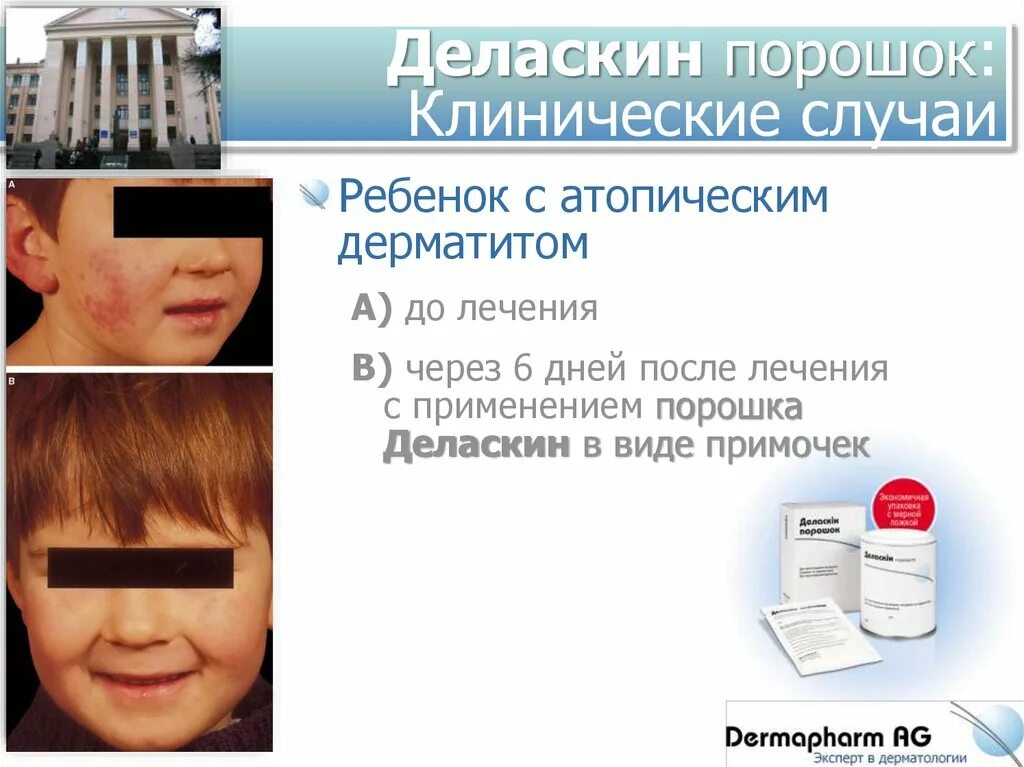 Виды атопического дерматита у детей фото Атопический дерматит клинические проявления: найдено 86 картинок