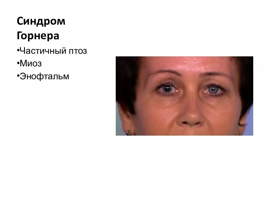 Синдром горнера это. Синдром горнера это