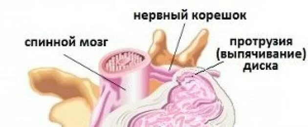 Предгрыжевое состояние. Предгрыжевое состояние позвоночника симптомы. Предгрыжевое состояние шейного отдела. Протрузия это предгрыжевое состояние.