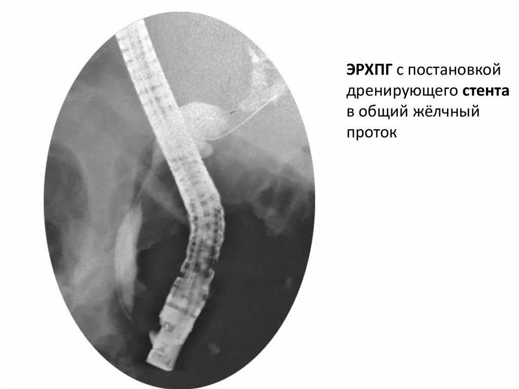Эндоскопическое стентирование желчного протока. Стент в желчном протоке на УЗИ. Стент общего желчного протока. Стент желчного протока