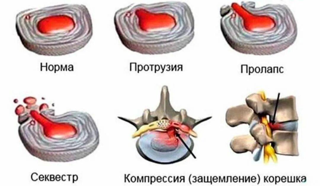 Пролапс диска. Межпозвоночная грыжа пульпозное ядро. пролапс протрузия экструзия. протрузия дисков позвоночника что это такое. выпячивание межпозвоночного диска.