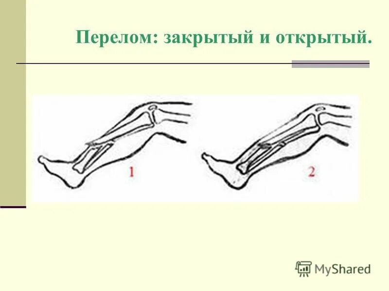 Открытые и закрытые передома. Открытые и закрытые переломы. Открытый перелом и закрытый перелом.