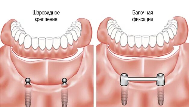 Балочная система фиксации протезов на имплантах. Балочная система фиксации протезов матрица. Балочная система фиксации коронок. Балочная система фиксации румпеля шредер. Как крепятся съемные