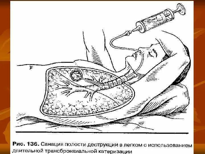 Что такое санация кишечника. Санкция трахиобронхиального дерева. Санация трахео-бронхиального дерева. Дренирование абсцесса методика. Санация трахеобронхиального дерева у пациентов на ИВЛ алгоритм.