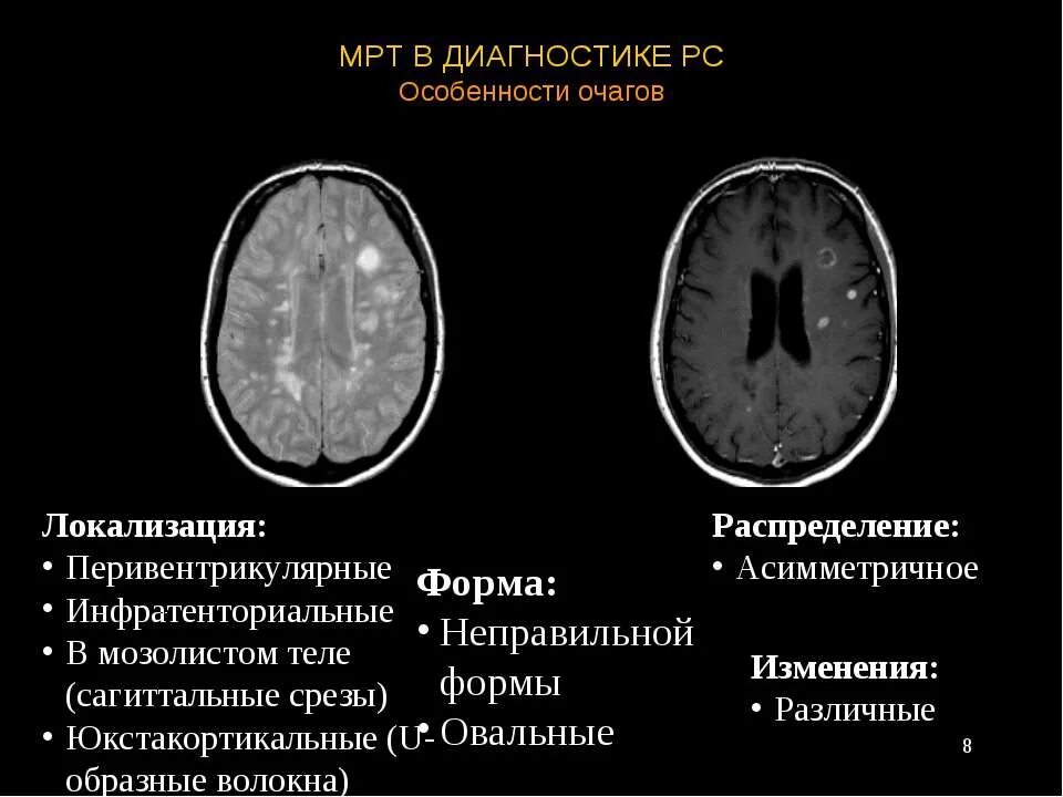 Единичный сосудистый очаг в лобной доле. Первертикулярные очаги. Перивентрикулярная локализация это. Перивентрикулярный очаг. Перивентрикулярные очаги мрт.