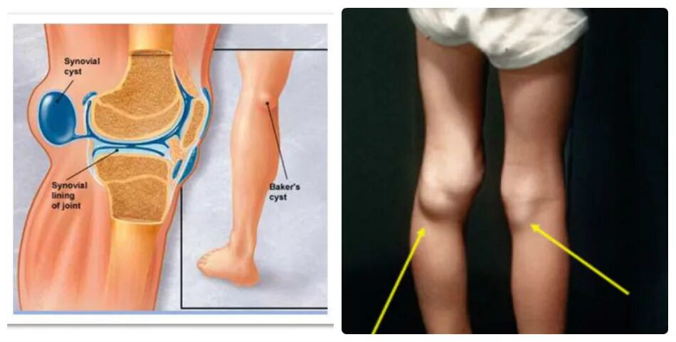 Киста Бейкера коленного сустава. Киста Бейкера (подколенная киста). Киста Бейкера коленного сустава опухоль. Подколенная грыжа Бейкера.
