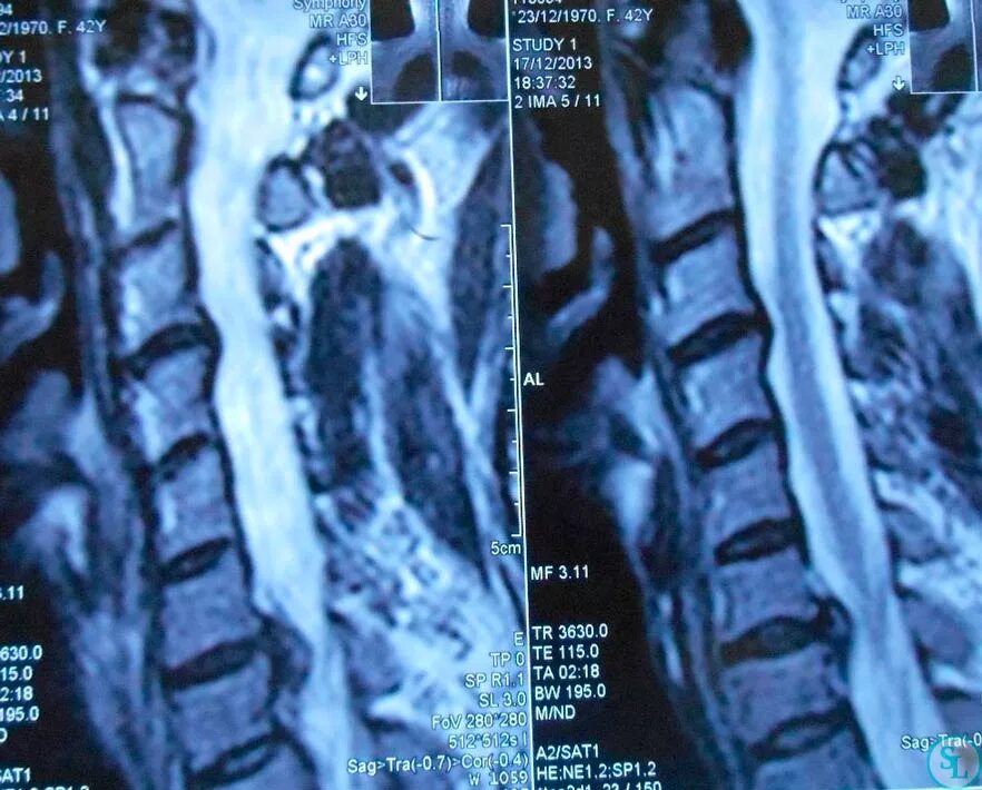 Грыжа 6 мм. Грыжа c5-c6 мрт. Диск с5-6 шейного отдела. Грыжа с6-с7 шейного отдела. Диски с6-с7 межпозвоночные.