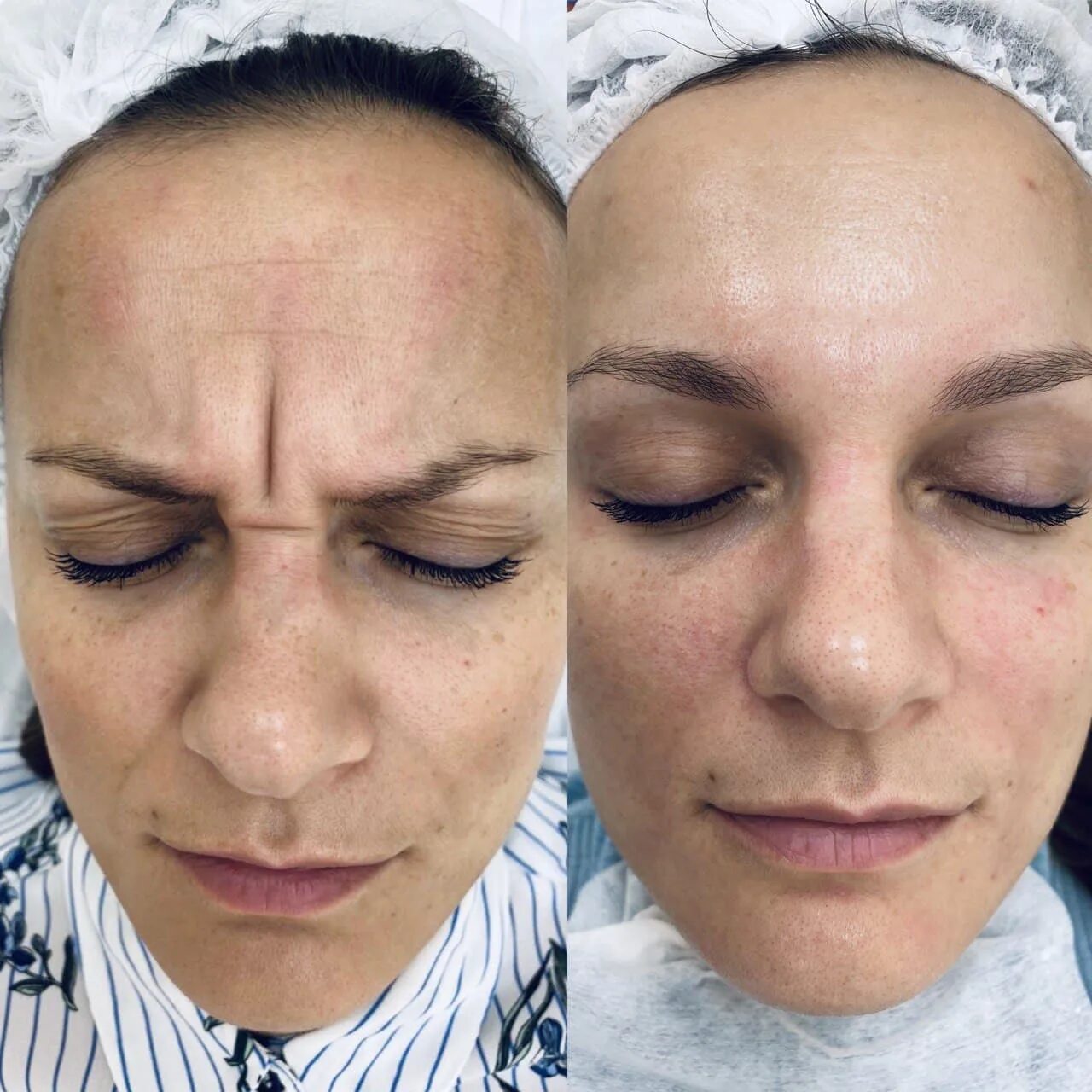 Ботокс после чистки лица. Косметические процедуры. Ботокс после чистки лица. Ботулинотерапия ксеомин. Ботокс для приподнятия бровей.