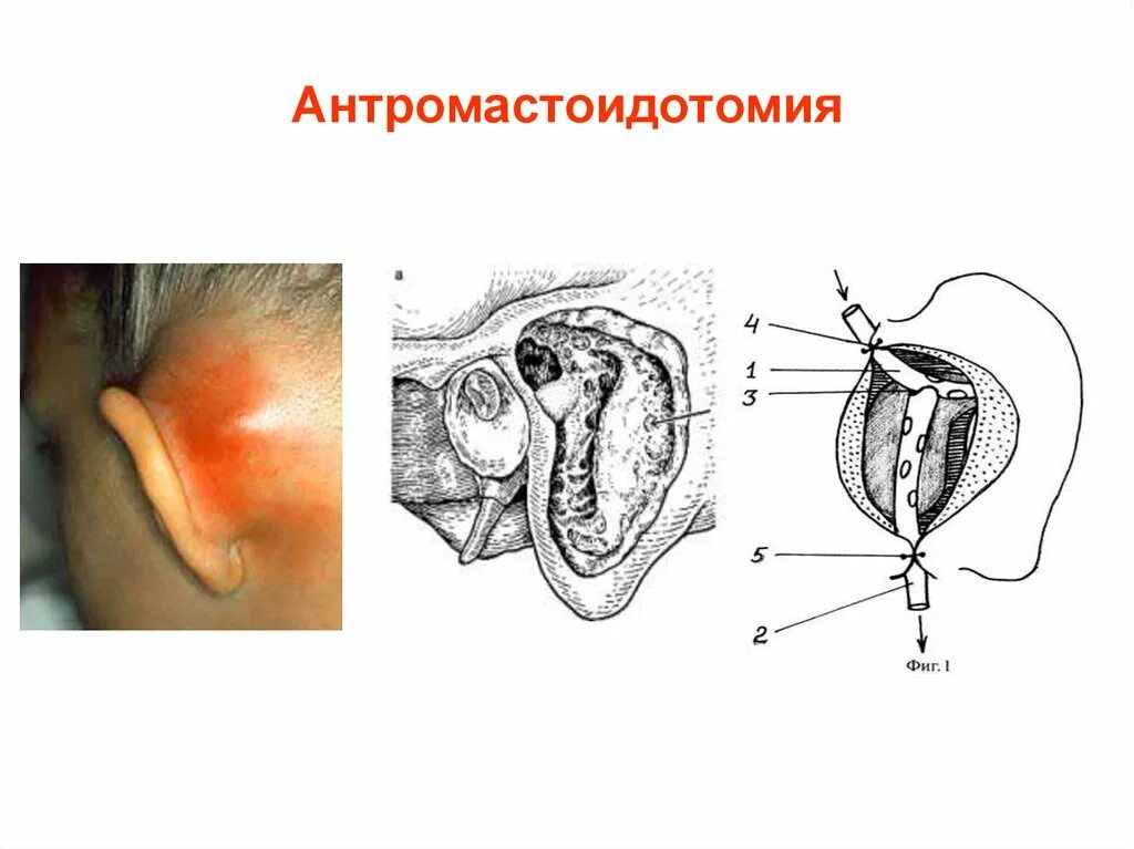 Правосторонний гнойный. Гнойный отит мастоидит. Гайморит отит мастоидит.