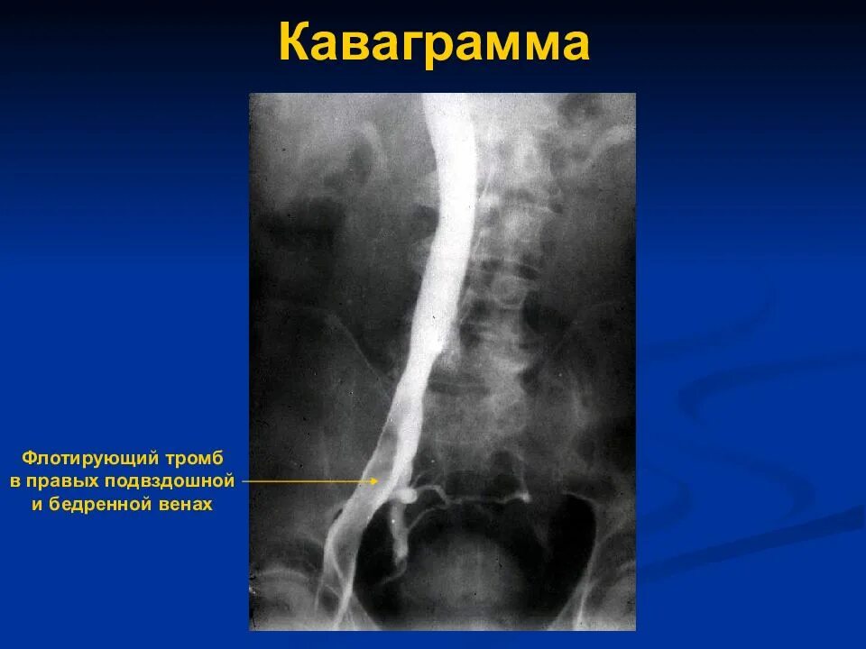 Флебография бедренной вены. Рентгеноконтрастная ретроградная илиокавография. Флотирующий тромб в бедренной Вене. Тромб в правом