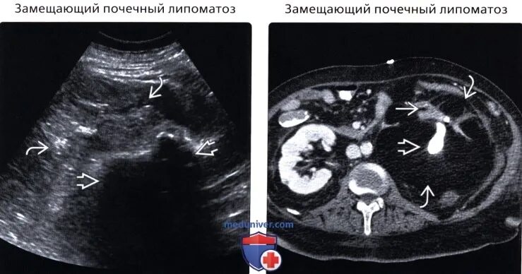 Образования в почке у мужчин. Кистозно-Солидное образование почки кт. Солидное образование почки. Солидно-кистозное образование почки УЗИ. Солидное образование почки на УЗИ.