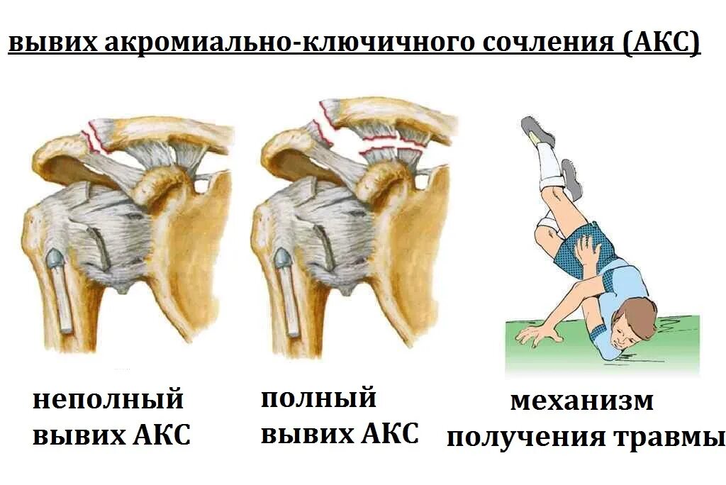 Разрыв сочленений. Вывих плечевого сустава с переломом. Вывих акромиально-ключичного сочленения. Разрыв акромиально-ключичного сочленения. Вывих акромиально-ключичного сустава.