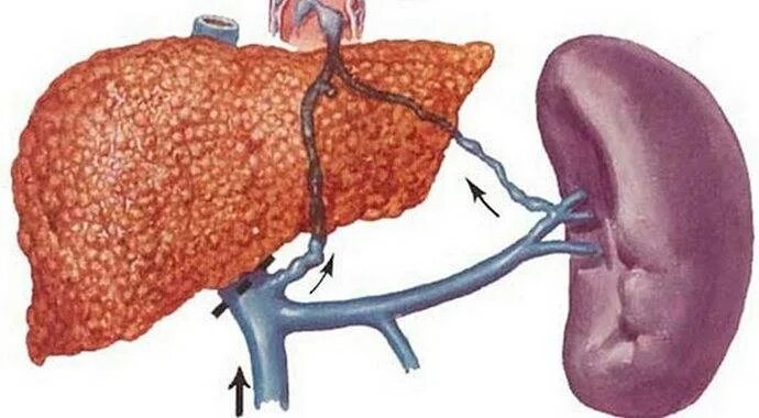 Больные печень и почки. Портальная гипертензия селезенки. Цирроз печени гепатолиенальный синдром. Портальный цирроз печени. Спленомегалия..