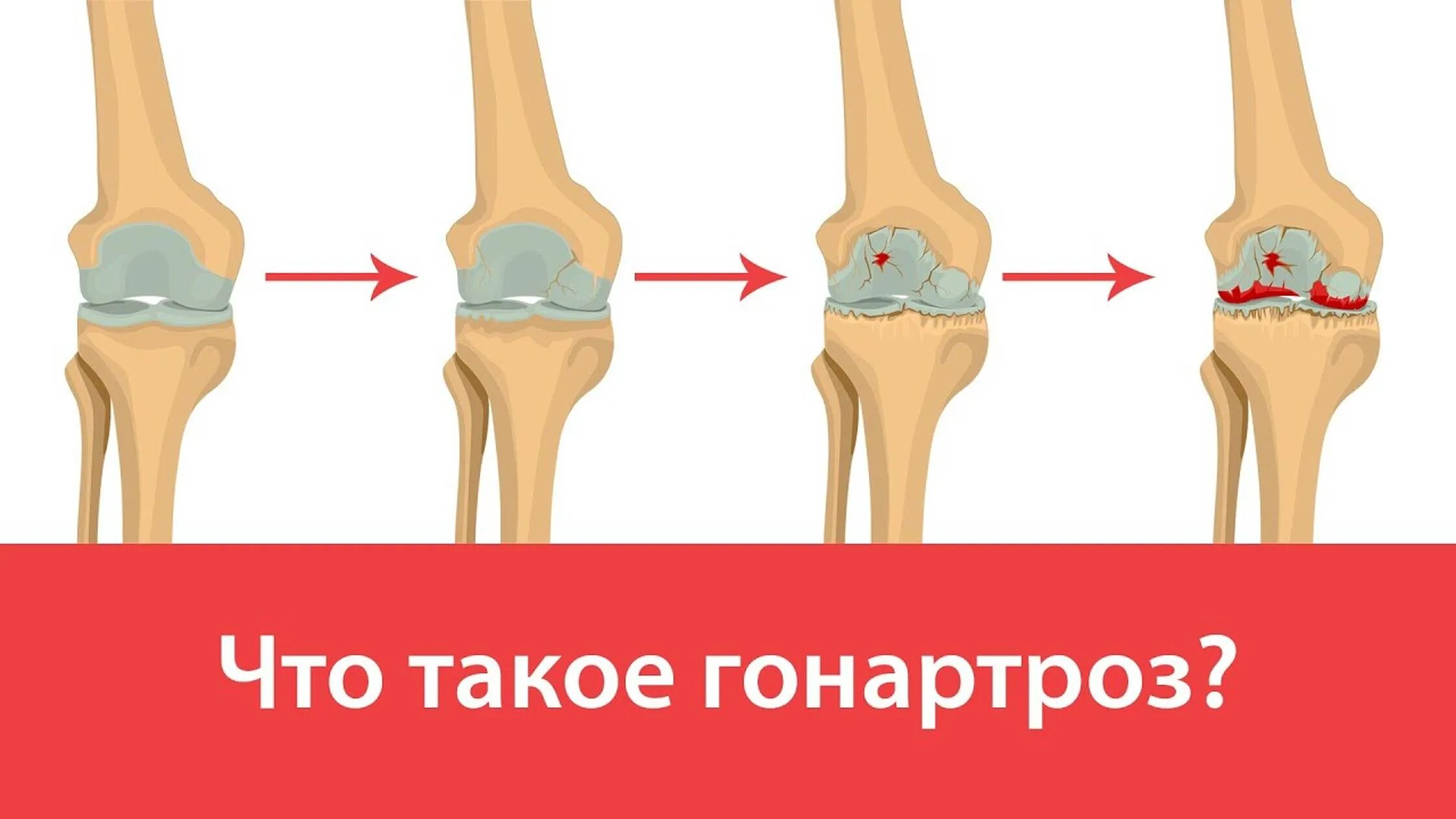 Деформирующий артроз коленного сустава. Гонартроз коленного сустава 2. Гонартроз коленного сустава 1. Гонартроз коленного сустава степени. Двухсторонний гонартроз коленных суставов.