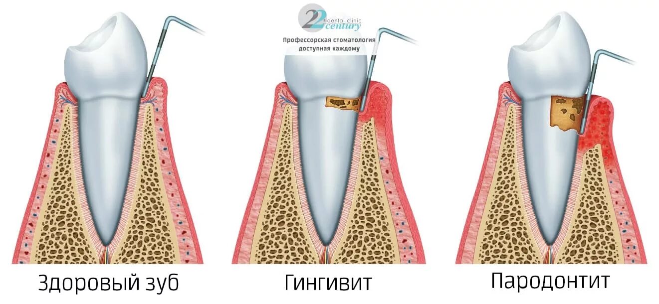 Пародонт стадии