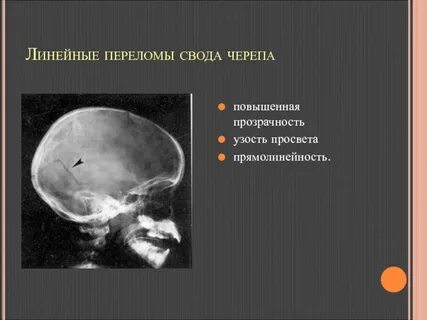 Чем могут сопровождаться переломы костей черепа