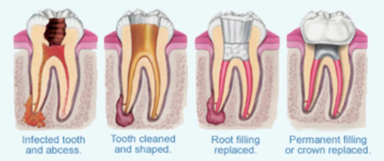 Воспаление канала зуба. Периодонтит свищевой ход хронический. Кариес пульпит периодонтит. 4 Канальный пульпит зуба. Что такое периодонтит в стоматологии.