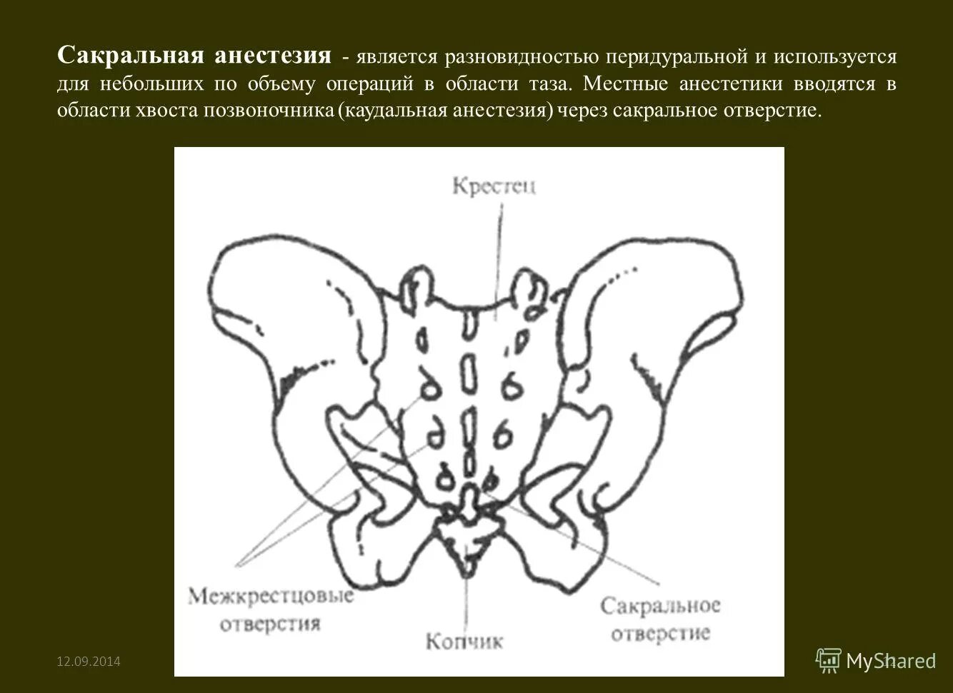 Эпидуральная анестезия собаке техника. Эпидуральная анестезия ,сакральная сакральная. Эпидуральная анестезия и катетеризация. Эпидурально сакральная анестезия. Эпидуральная блокада копчика.