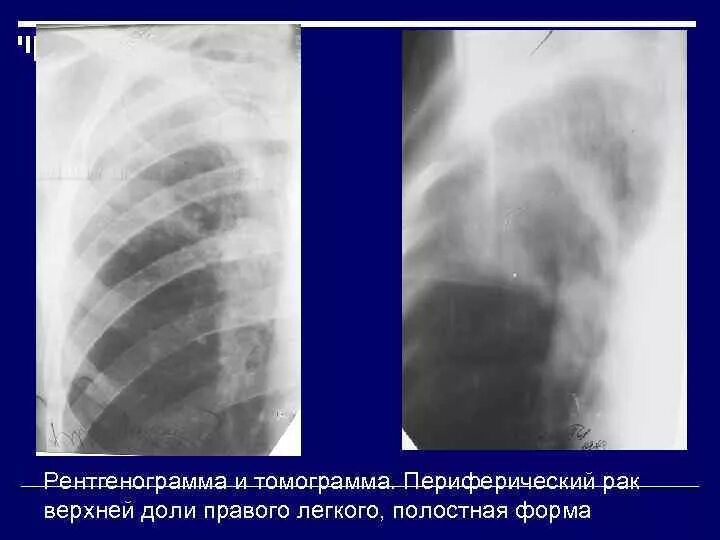 Образование в легком форму. Перифирический очаг верхней доли правого легкого. образование верхней доли правого легкого. периферический c-r нижней доли правого легкого. шаровидное образование в легком.