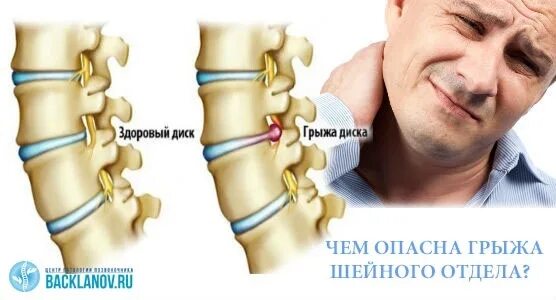 Межпозвоночная шейная грыжа. Грыжа шеного от. Шейная грыжа лечение без операции