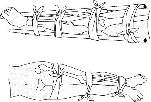 Кровотечение при открытом переломе голени. Перелом голени иммобилизация. Иммобилизация при переломе голени. Открытый перелом голени иммобилизация. Иммобилизация и аутоиммобилизация.