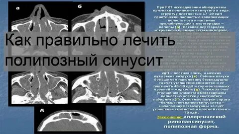 Полипозный синусит