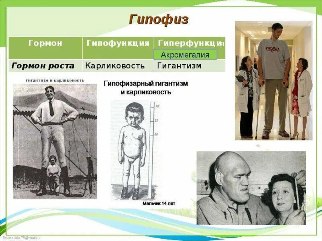 Заболевание гормона роста. Гипофункция щитовидной железы карликовость. Гигантизм и карликовость гипофиз. Гипофиз гигантизм карликовость акромегалия. Гиперфункция гормонов гипофиза.