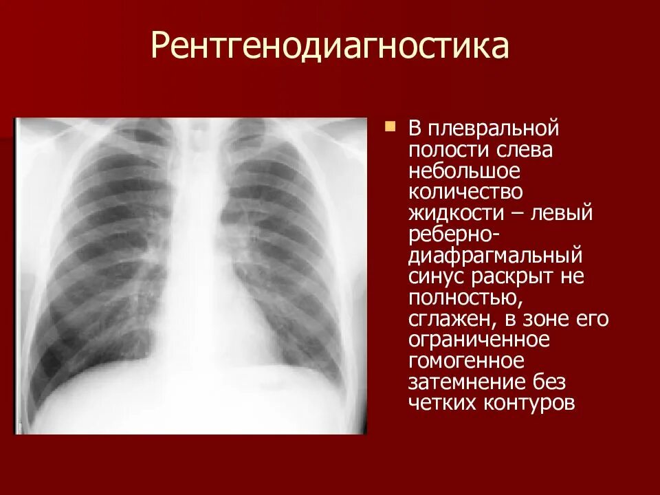 Синус слева. Затемнение реберно-диафрагмальных синусов. реберно-диафрагмальный синус. облитерация реберно-диафрагмального синуса. облитерирован синус легкого.