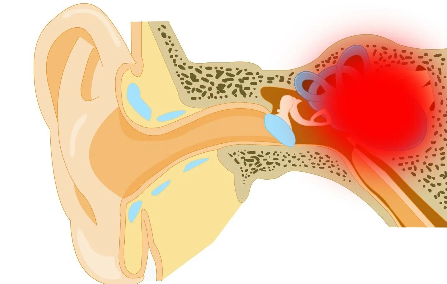 Менингогенный лабиринтит. Травматический лабиринтит. Внутренний отит (лабиринтит). Тимпаногенный лабиринтит. Причины воспаления среднего уха