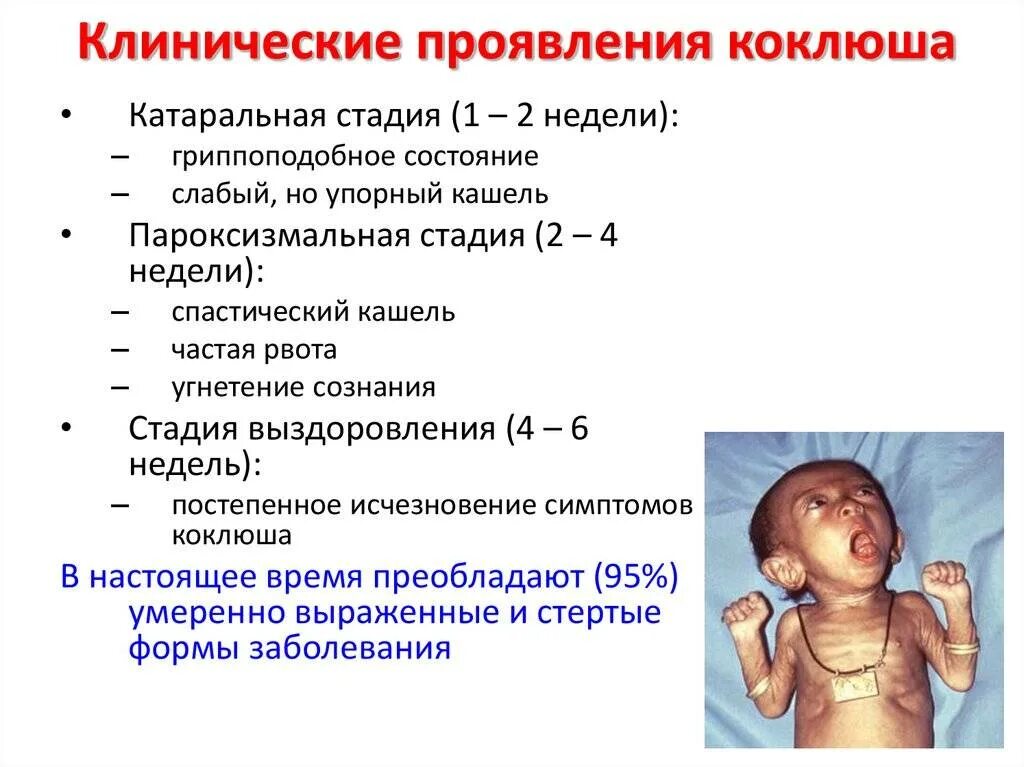 Признаки коклюша у взрослых лечение. Коклюш характерные клинические проявления заболевания. Характерные клинические симптомы коклюша. Коклюш специфические симптомы. Коклюш симптомы у детей 1 год 3 месяца.