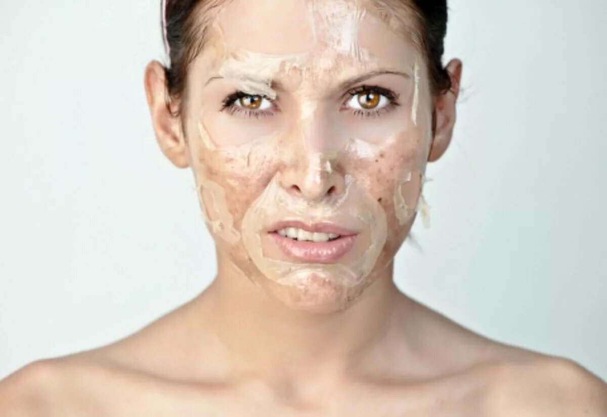 Химический пилинг джесснера. Срединный химический пилинг. Салициловый пилинг джесснера. Пилинг для лица. Пилинг джесснера ожог кожи.