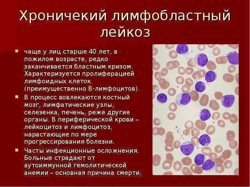 Острый лимфоцитарный лейкоз. Лимфобластный лейкоз бластные клетки. Острый лейкоз мазок крови. Острый лейкоз картина крови. Кровь при лимфолейкозе