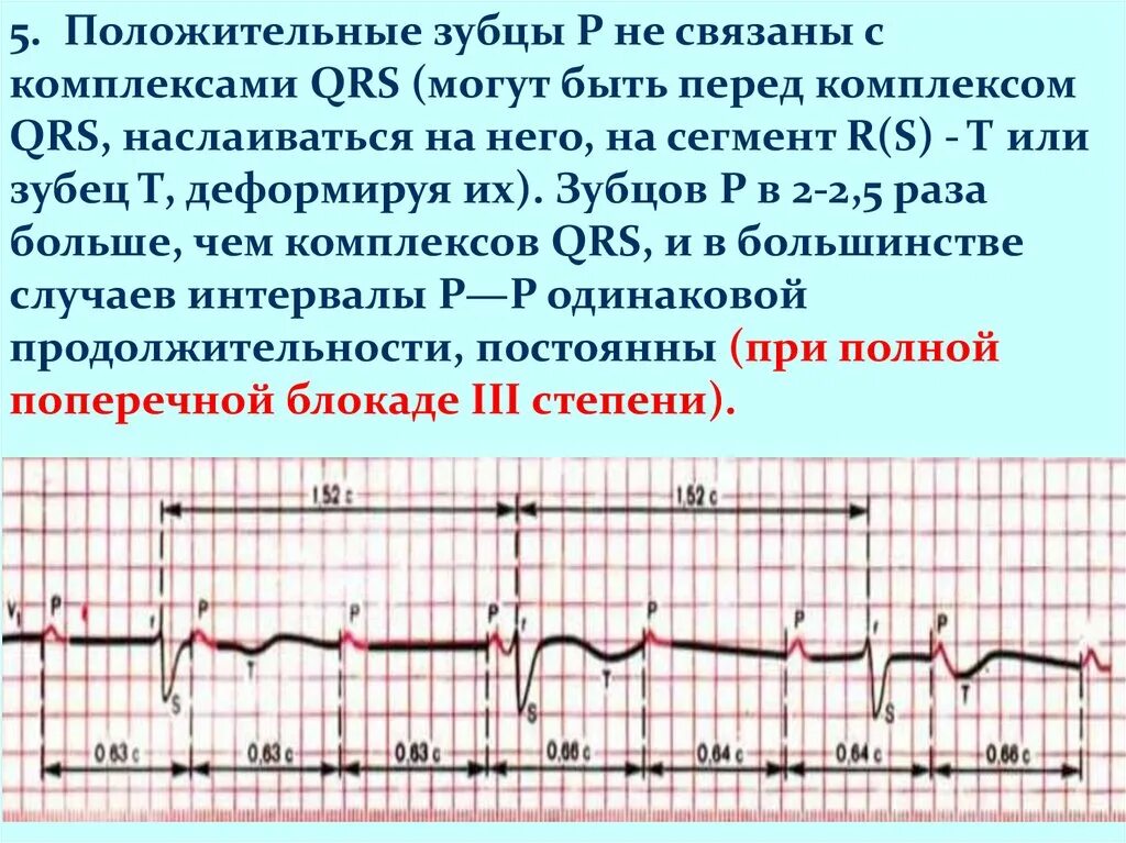 Qrs на экг что это. Отрицательный зубец р после QRS комплекса. Двухфазный зубец р на ЭКГ В норме. Двухфазный зубец r на ЭКГ. ЭКГ зубец р наслаивается на QRS.