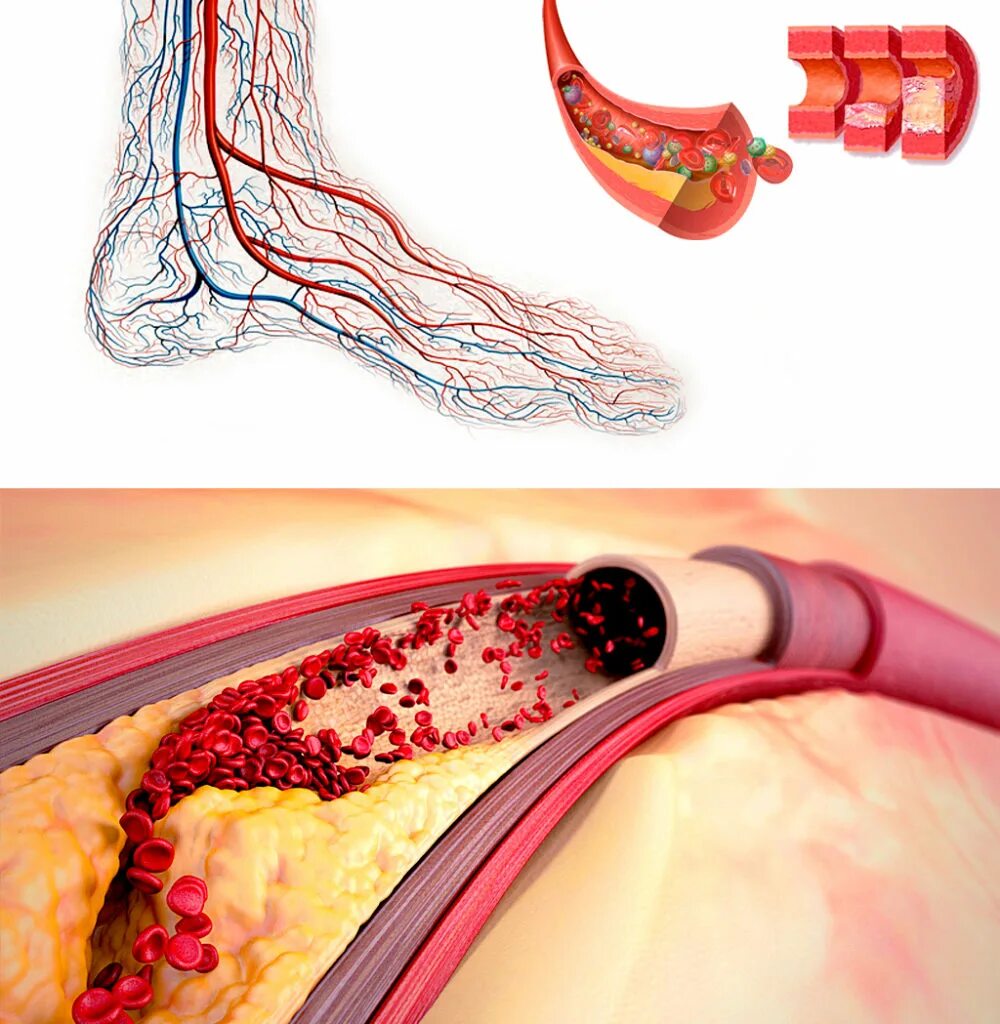 Нарушение кровообращения болезни. Менкеберга атеросклероз. Диабетическая макроангиопатия атеросклероз. Атеросклеротическое поражение кровеносных сосудов.