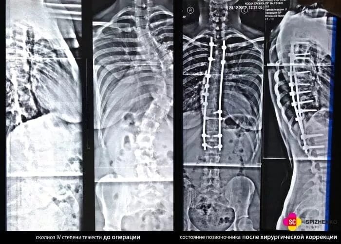 Операция по исправлению сколиоза. Хирургическая коррекция сколиоза. степени сколиоза позвоночника по тяжести. операция исправление сколиоза 4 степени. исправление позвоночника операционной.