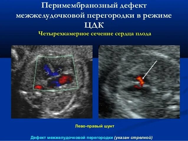 Дмжп 3 мм. Перимембранозный дефект межжелудочковой перегородки. дмжп перимембранозный на узи. перимембранозный дефект мжп. перимембранозный дмжп на узи протокол.