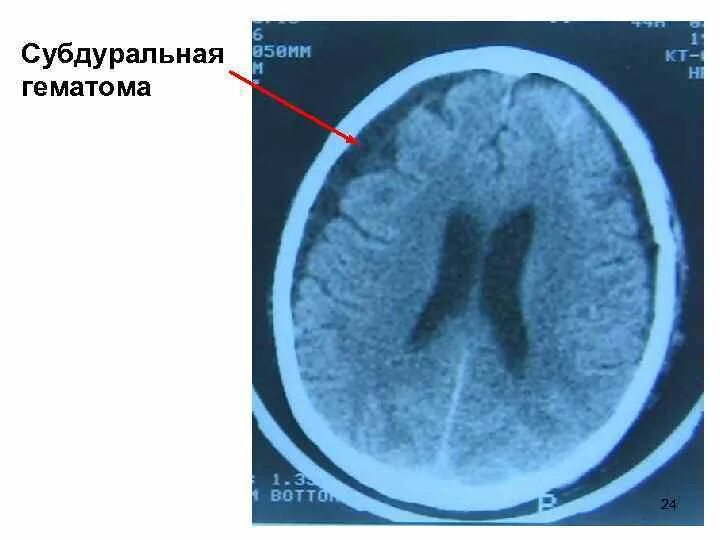 Гематома черепно мозговой травме. Внутричерепная субдуральная гематома. Гематома субдуральная травматическая. Кт субдуральной гематомы. Хроническая субдуральная гематома.