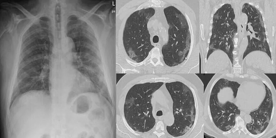 Параканкрозная пневмония на кт. Ковидная пневмония на кт. Кт легких пневмония коронавирус. Кт легких ковид