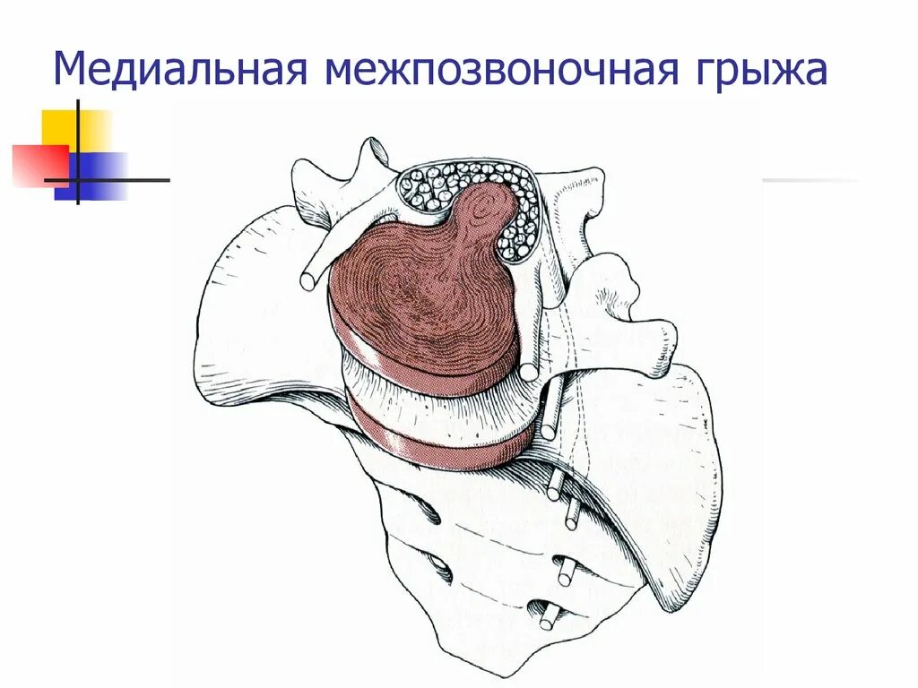 Латеральная грыжа диска. Грыжа позвоночника диска медиальная. медиально парамедиальная грыжа диска. медианная грыжа позвоночника поясничного отдела. медиально-парамедиальная грыжа l5s1.
