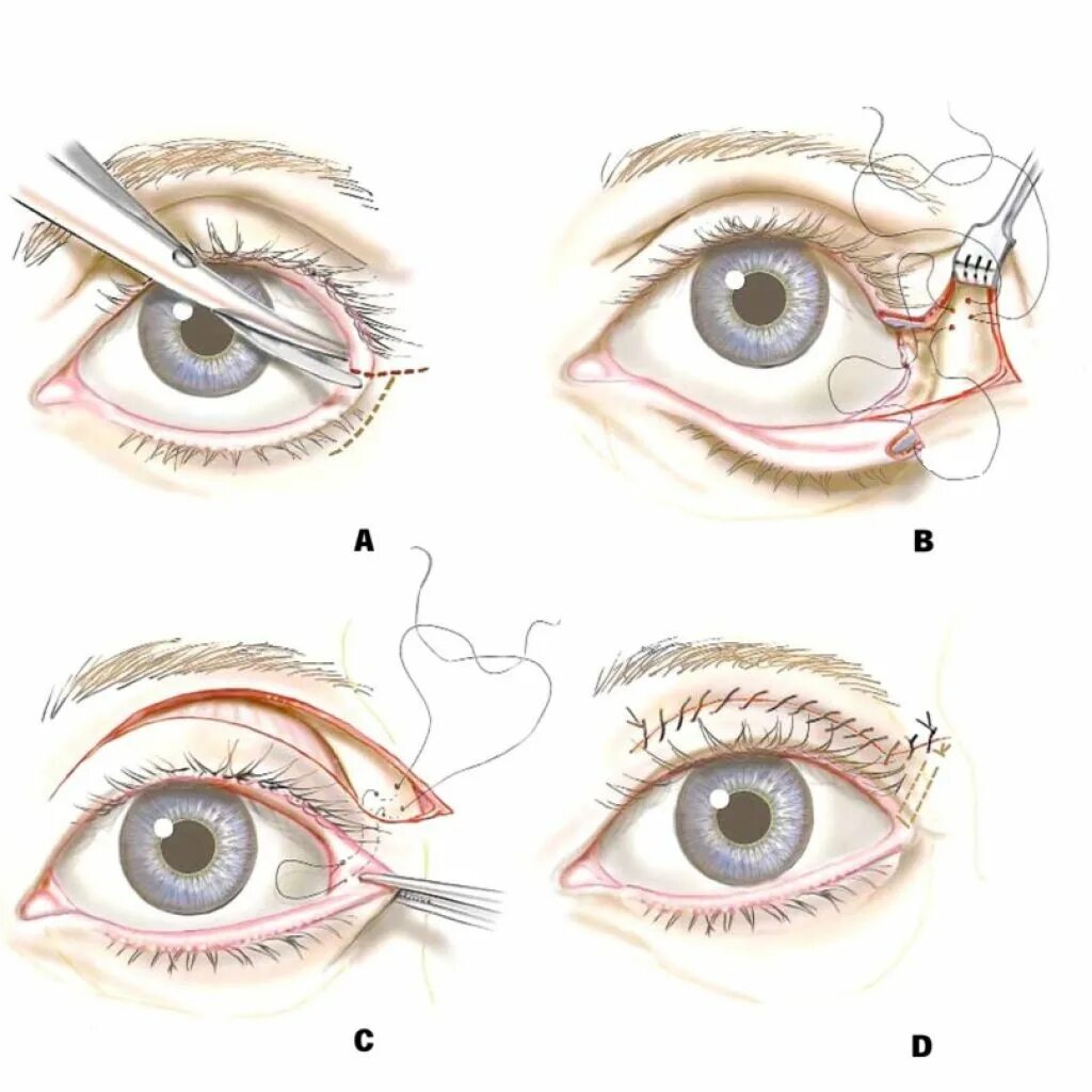 Как изменяются века. Кантопластика и кантопексия. Латеральная кантопексия. Латеральная кантопластика глаз. Кантопексия, кантопластика (подтяжка угла глаза).