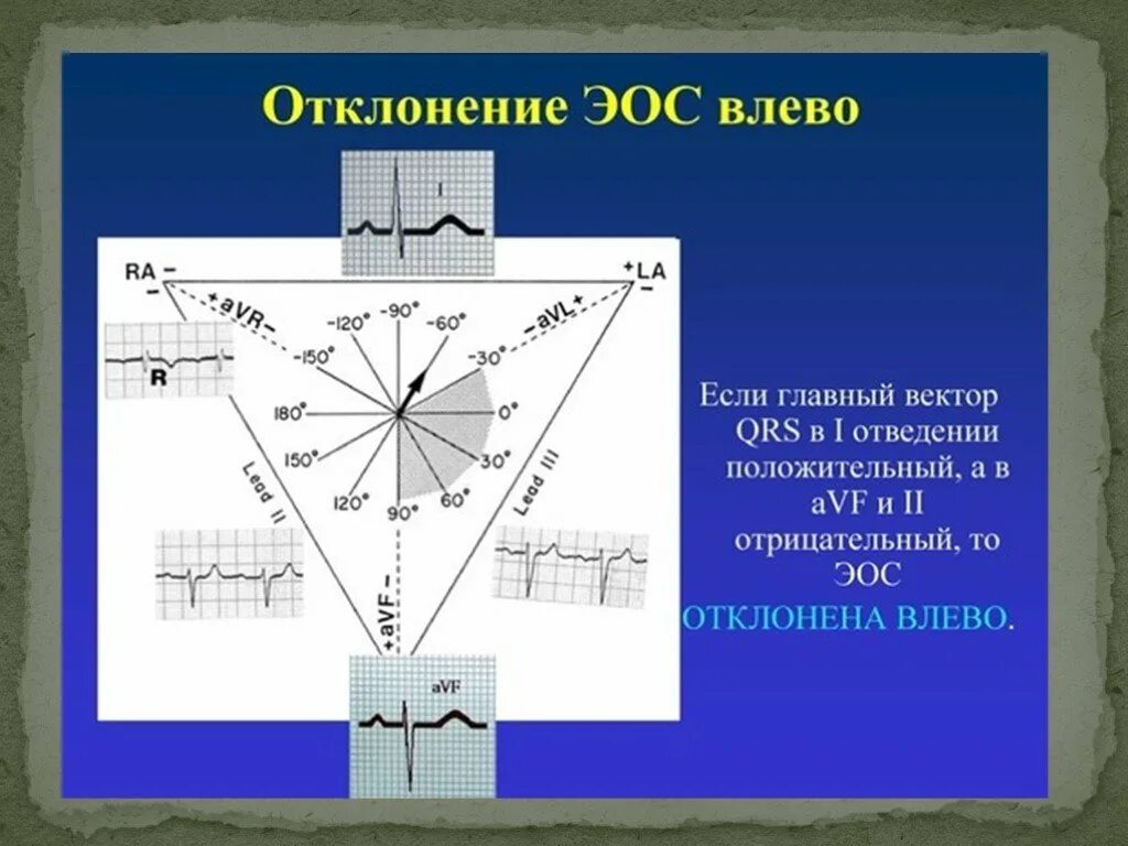 Смещение эос влево. Отклонение оси влево на экг. смещение оси влево на экг. смещение оси сердца влево на экг. резкое отклонение электрической оси.