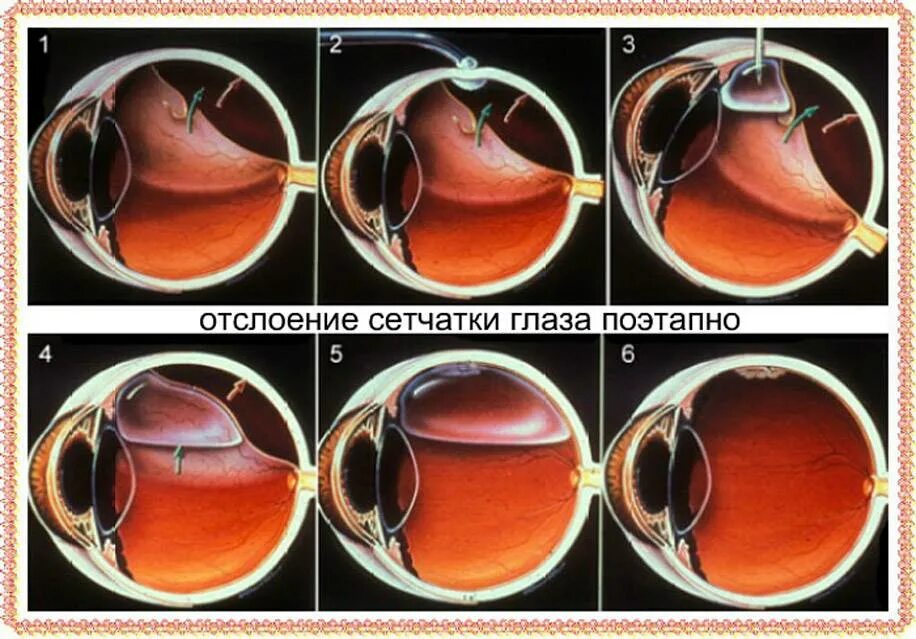 Отслойка сетчатки офтальмоскопия. Отслойка сетчатки катаракта. Регматогенная отслойка сетчатки. Воронкообразная отслойка сетчатки.