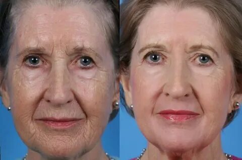 Пилинг лица для 50 лет