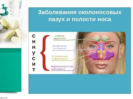 Гайморит лечение название