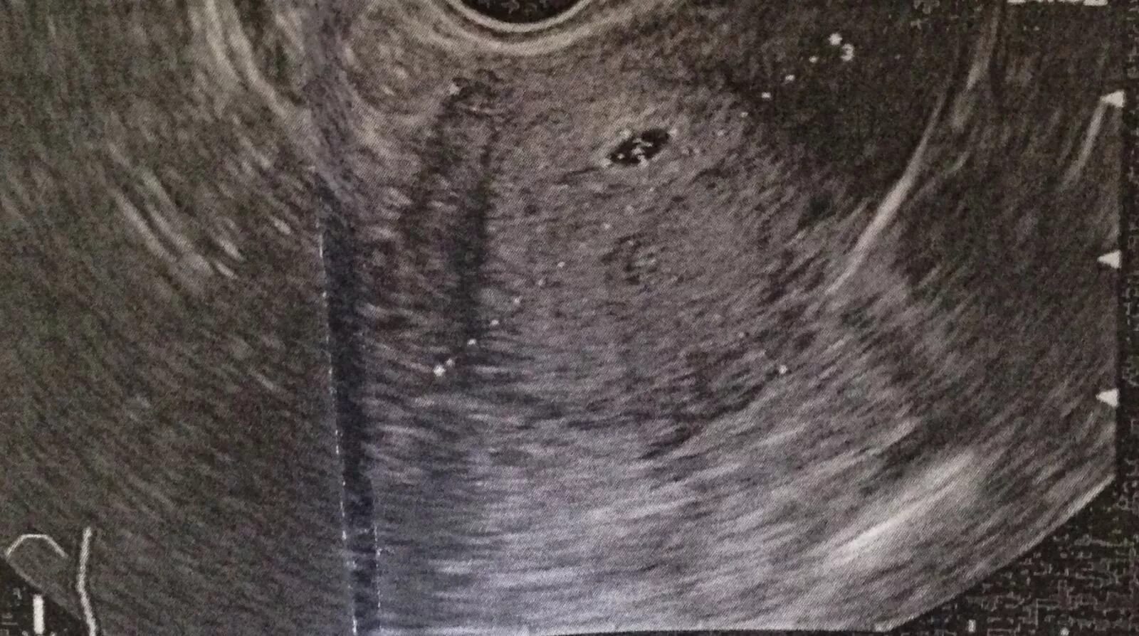 УЗИ 2-3 недели беременности. УЗИ 2 недели беременности. Снимок УЗИ на 3 неделе беременности. УЗИ 4 недели беременности. Узи 3 4 недели