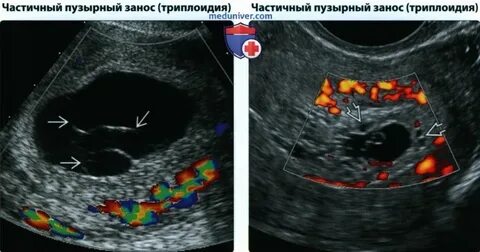 Непузырный занос при замершей это