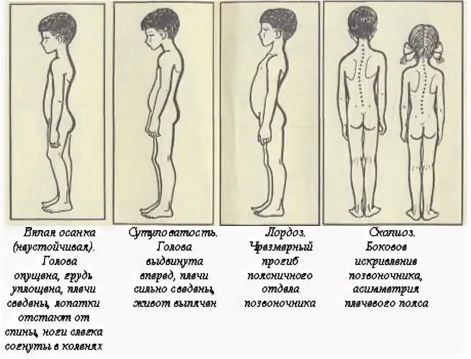 Неправильная осанка у детей. Ребенок со спины. Осмотр осанки. Правильная осанка мальчика. Искривление осанки у детей.